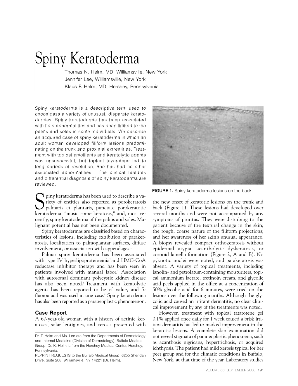 Spiny Keratoderma Thomas N