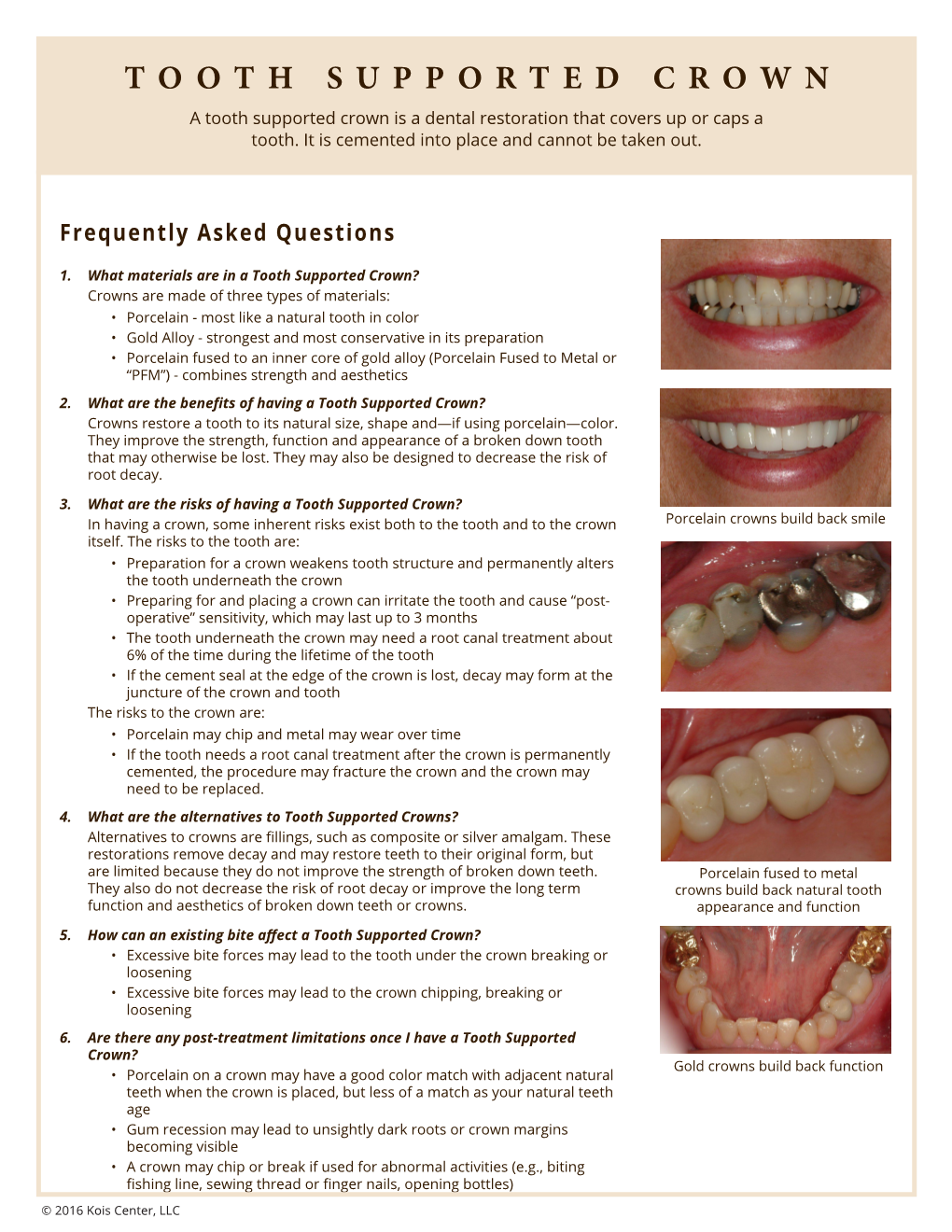 TOOTH SUPPORTED CROWN a Tooth Supported Crown Is a Dental Restoration That Covers up Or Caps a Tooth