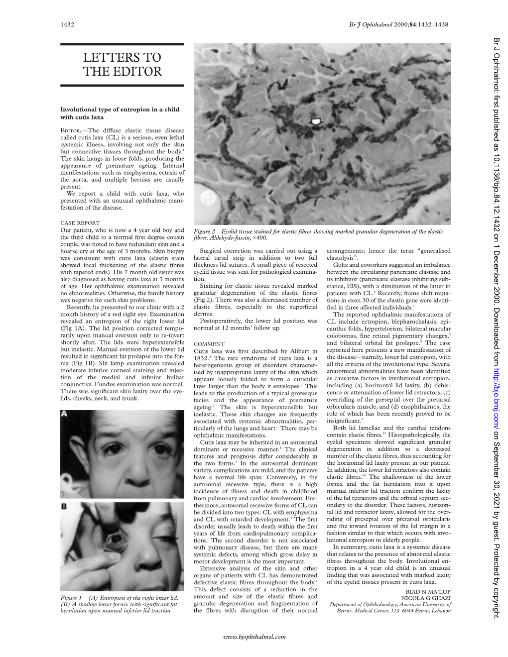 Involutional Type of Entropion in a Child with Cutis Laxa