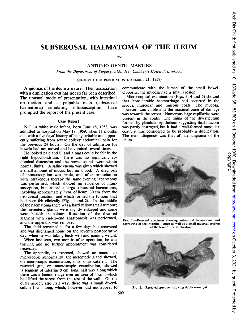 Subserosal Haematoma of the Ileum