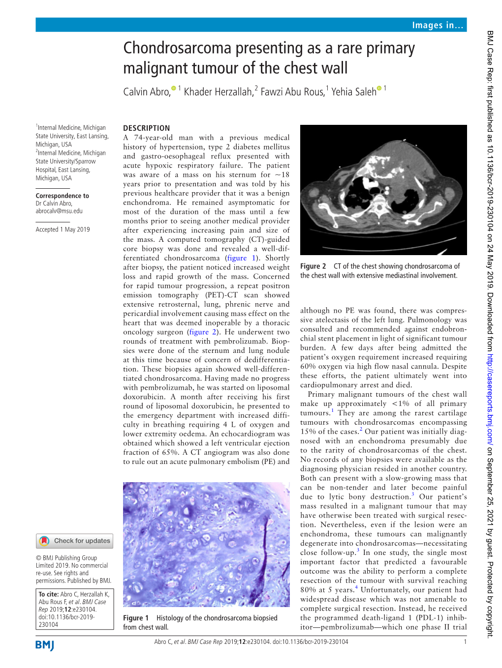 Chondrosarcoma Presenting As a Rare Primary Malignant Tumour of the Chest Wall Calvin Abro, 1 Khader Herzallah,2 Fawzi Abu Rous,1 Yehia Saleh 1