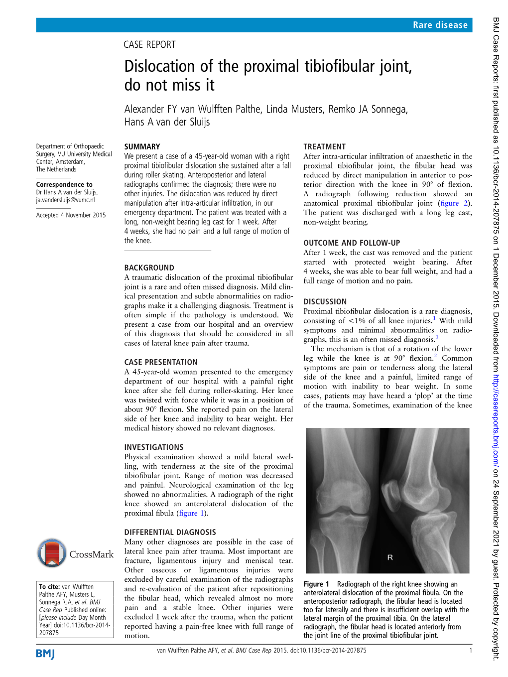 Dislocation of the Proximal Tibiofibular Joint, Do Not Miss It