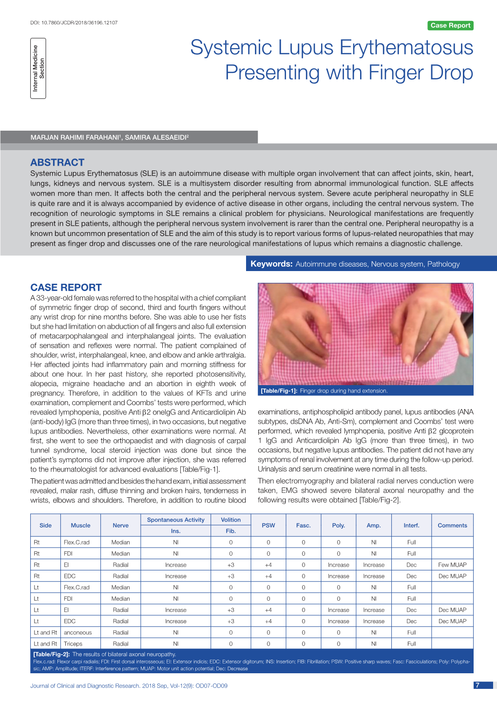 Systemic Lupus Erythematosus Presenting with Finger Drop