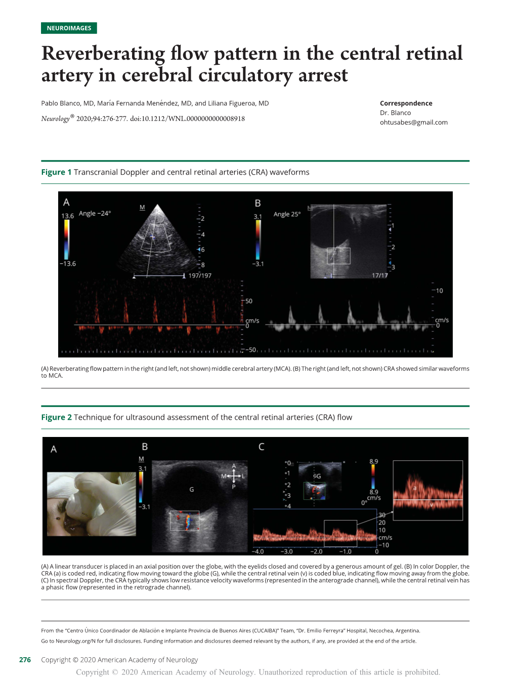 Reverberating Flow Pattern in the Central Retinal Artery in Cerebral