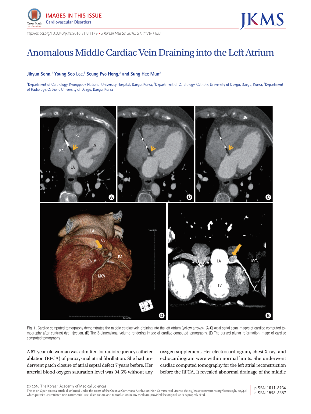 Anomalous Middle Cardiac Vein Draining Into the Left Atrium