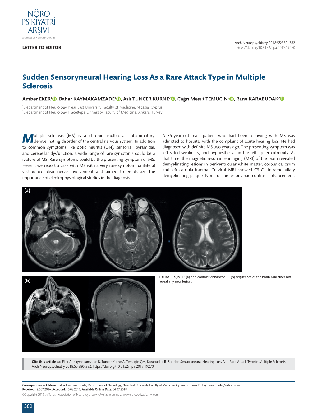 Sudden Sensoryneural Hearing Loss As a Rare Attack Type in Multiple Sclerosis