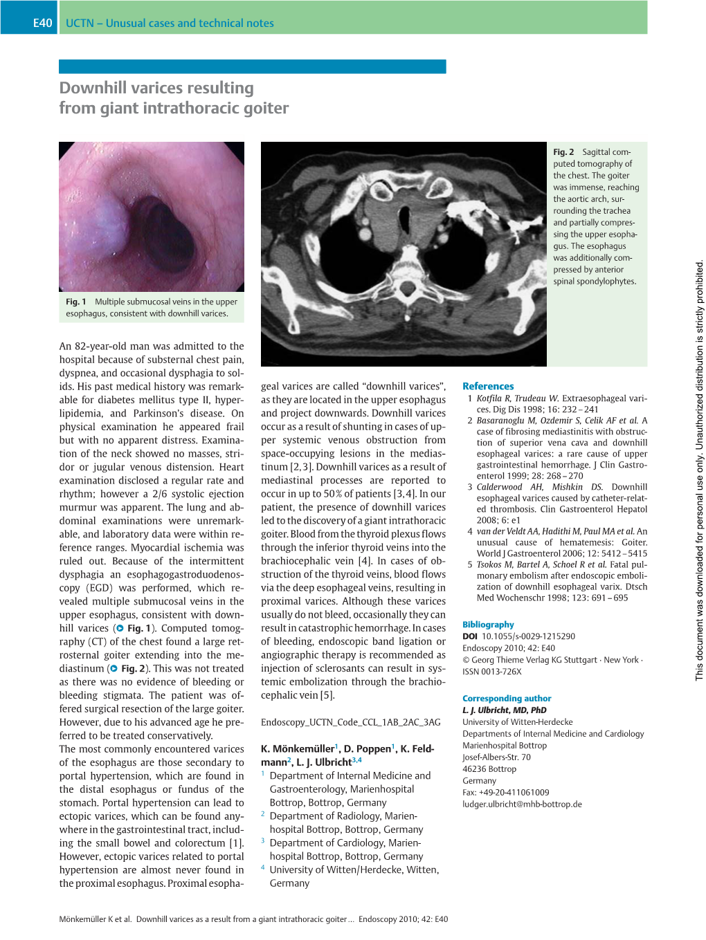 Downhill Varices Resulting from Giant Intrathoracic Goiter