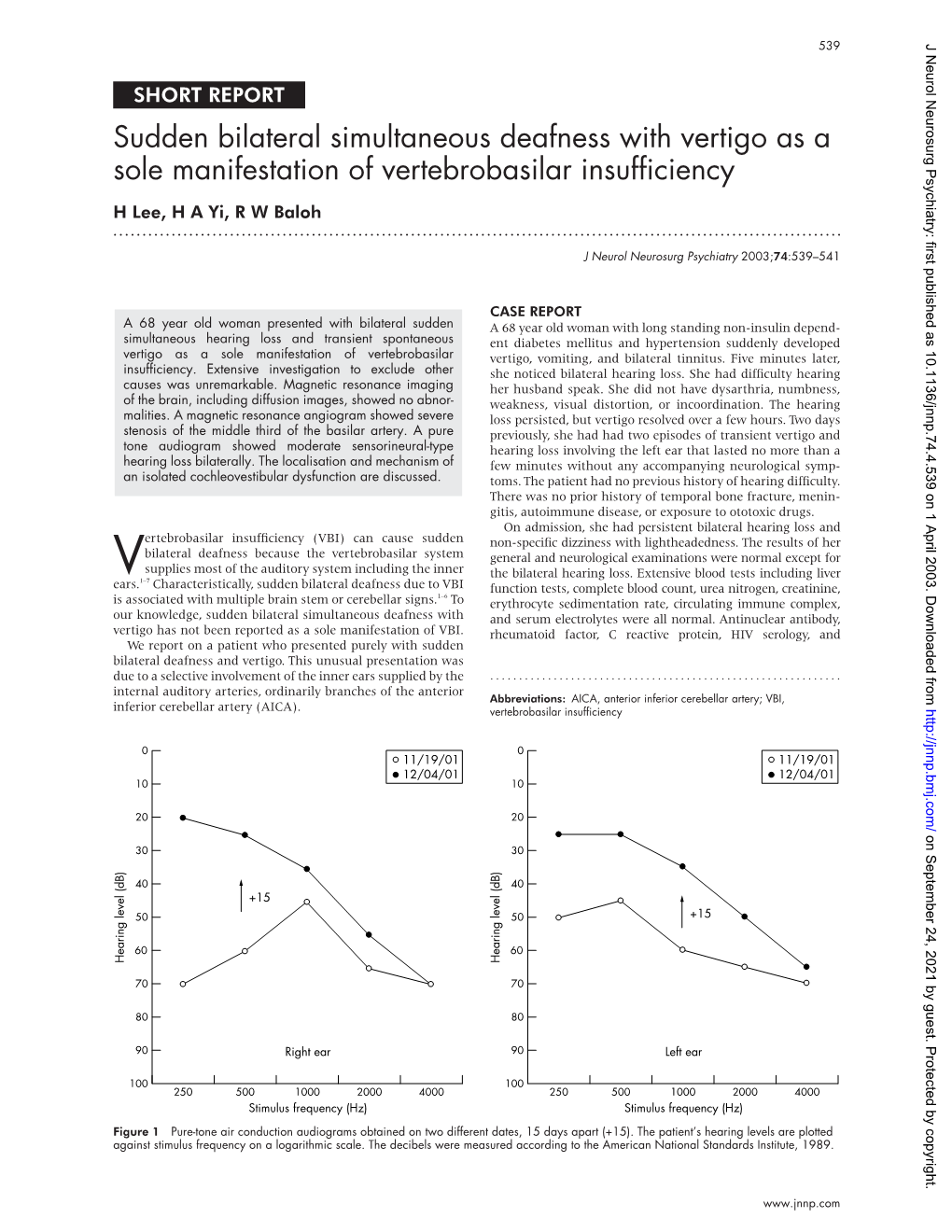 Sudden Bilateral Simultaneous Deafness with Vertigo As a Sole Manifestation of Vertebrobasilar Insufficiency H Lee, H a Yi, R W Baloh