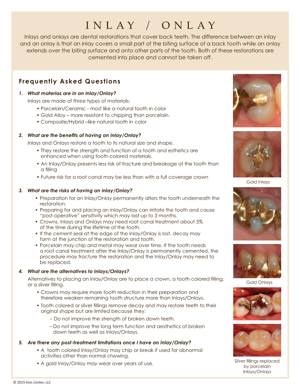 INLAY / ONLAY Inlays and Onlays Are Dental Restorations That Cover Back Teeth