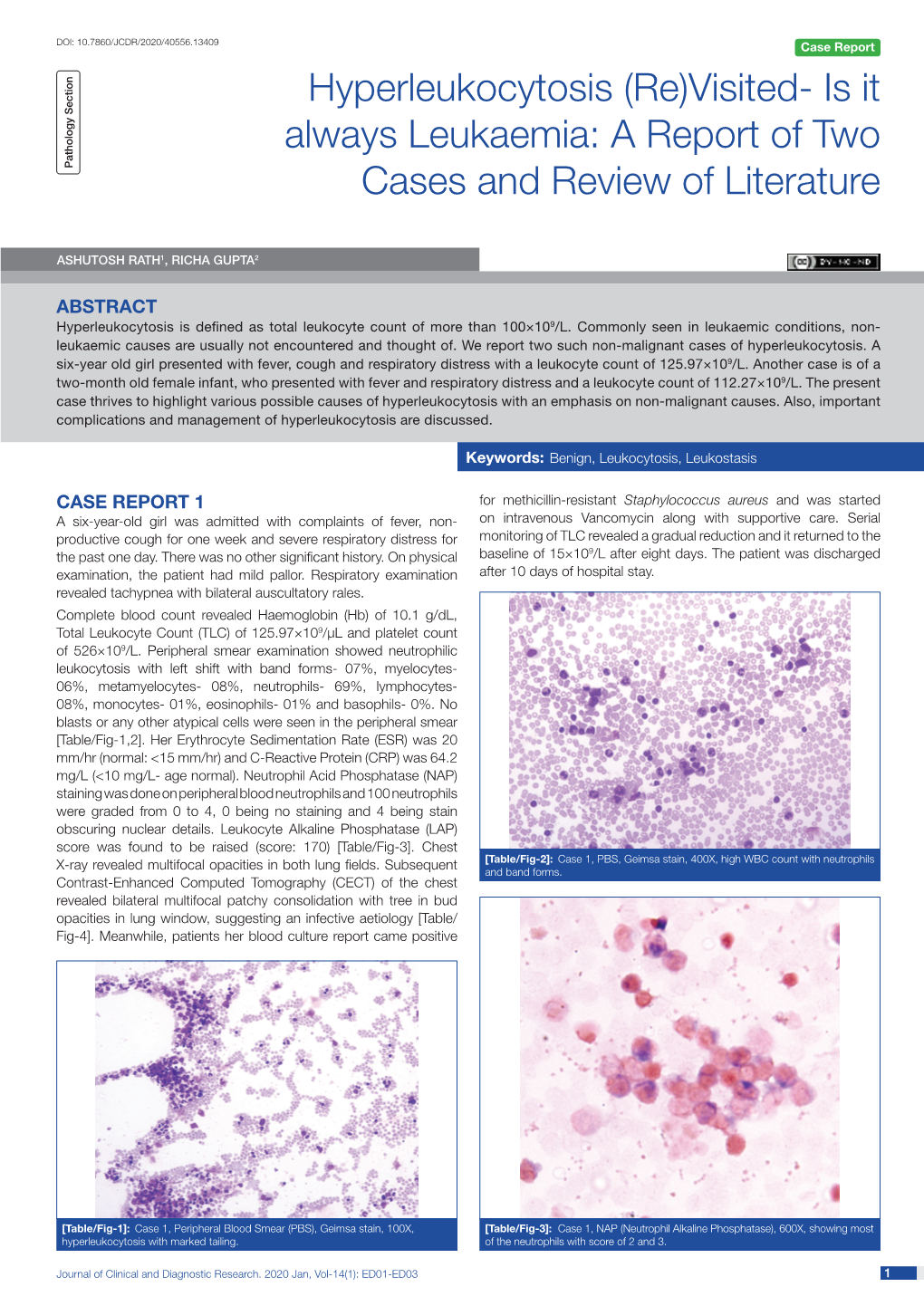 Hyperleukocytosis (Re)Visited- Is It Case Series Always Leukaemia: a Report of Two Pathology Section Cases and Review of Literature Short Communication