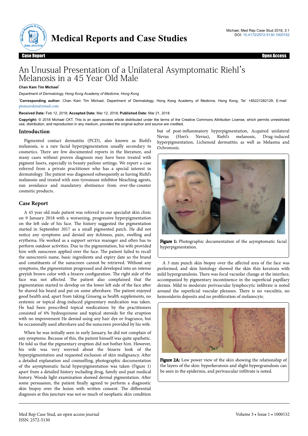 An Unusual Presentation of a Unilateral Asymptomatic Riehl's