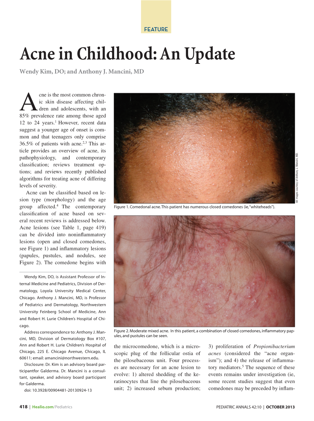 Acne in Childhood: an Update Wendy Kim, DO; and Anthony J