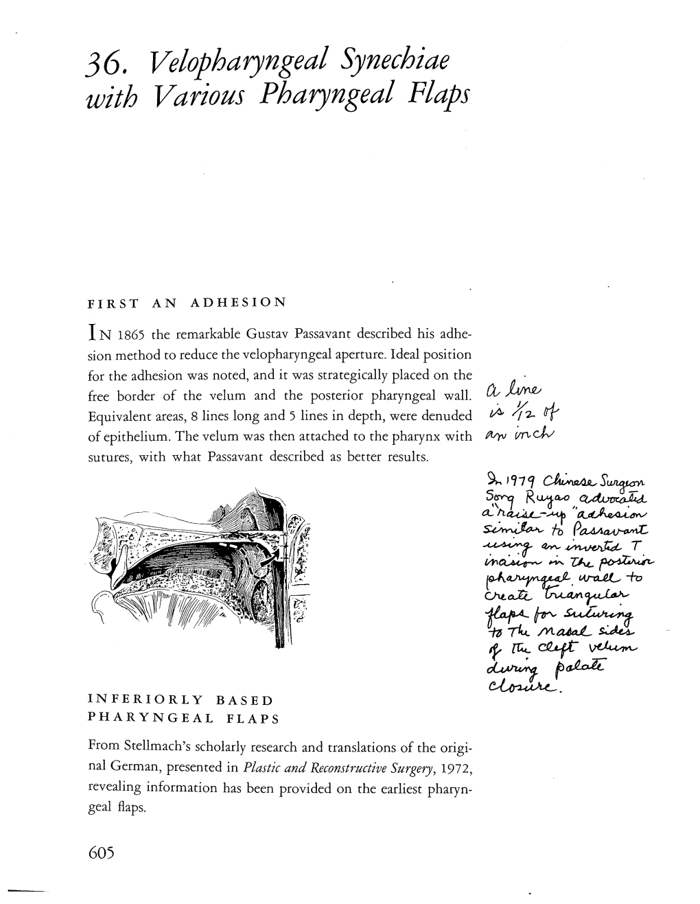 36. Velopharyngeal Synechiae with Various Pharyngeal Flaps