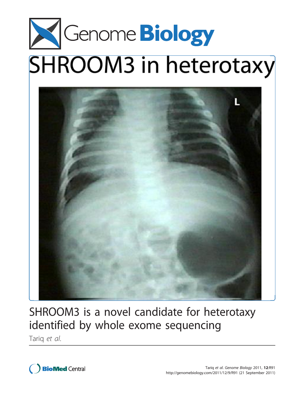 SHROOM3 Is a Novel Candidate for Heterotaxy Identified by Whole Exome Sequencing Tariq Et Al