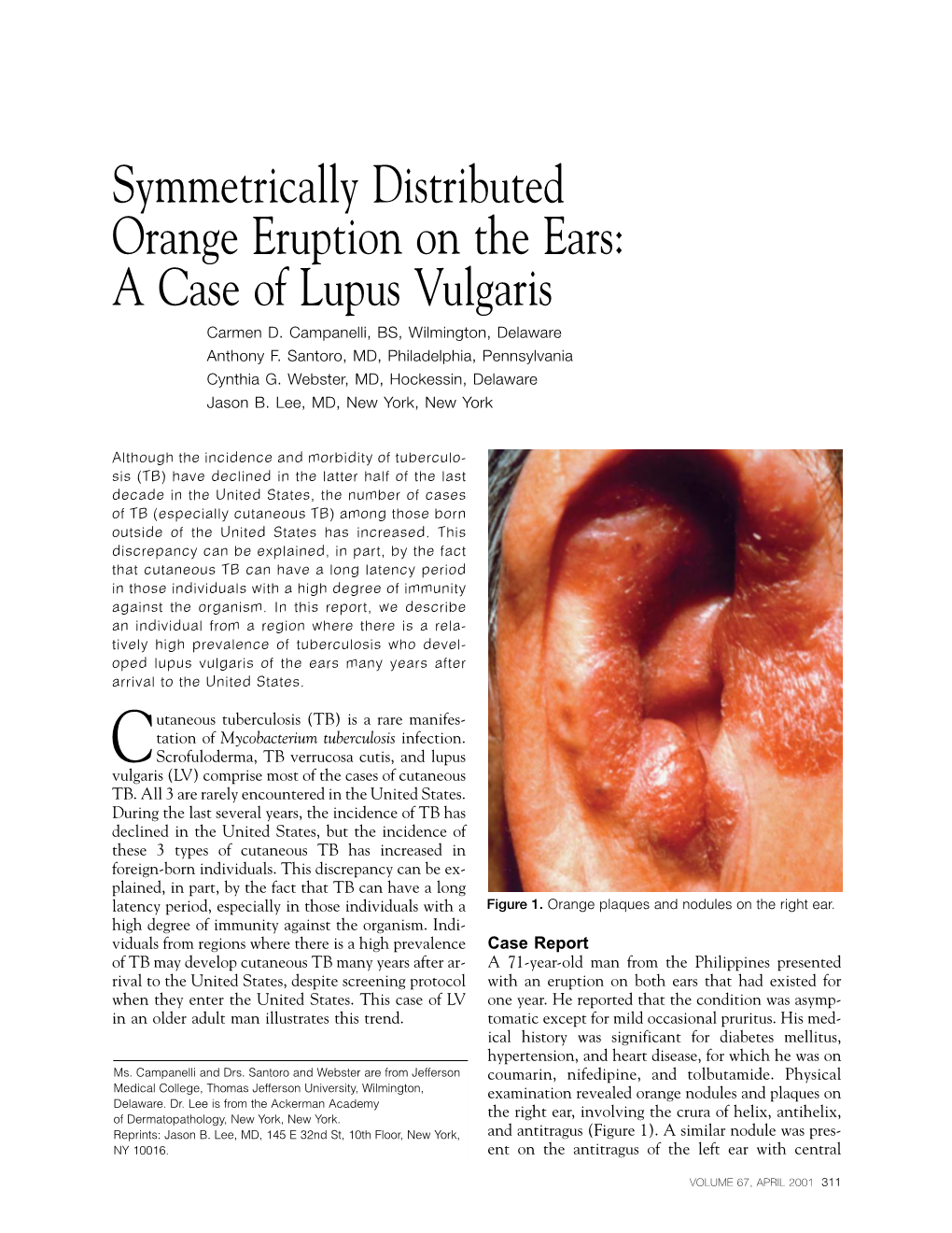 A Case of Lupus Vulgaris Carmen D