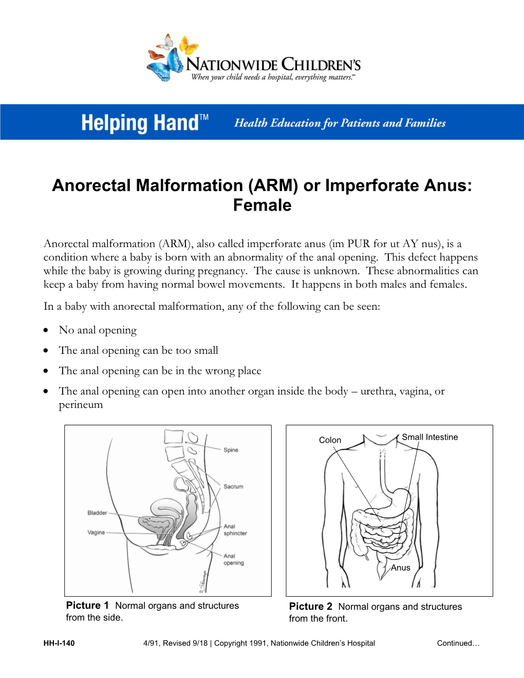 Anorectal Malformation (ARM) Or Imperforate Anus: Female