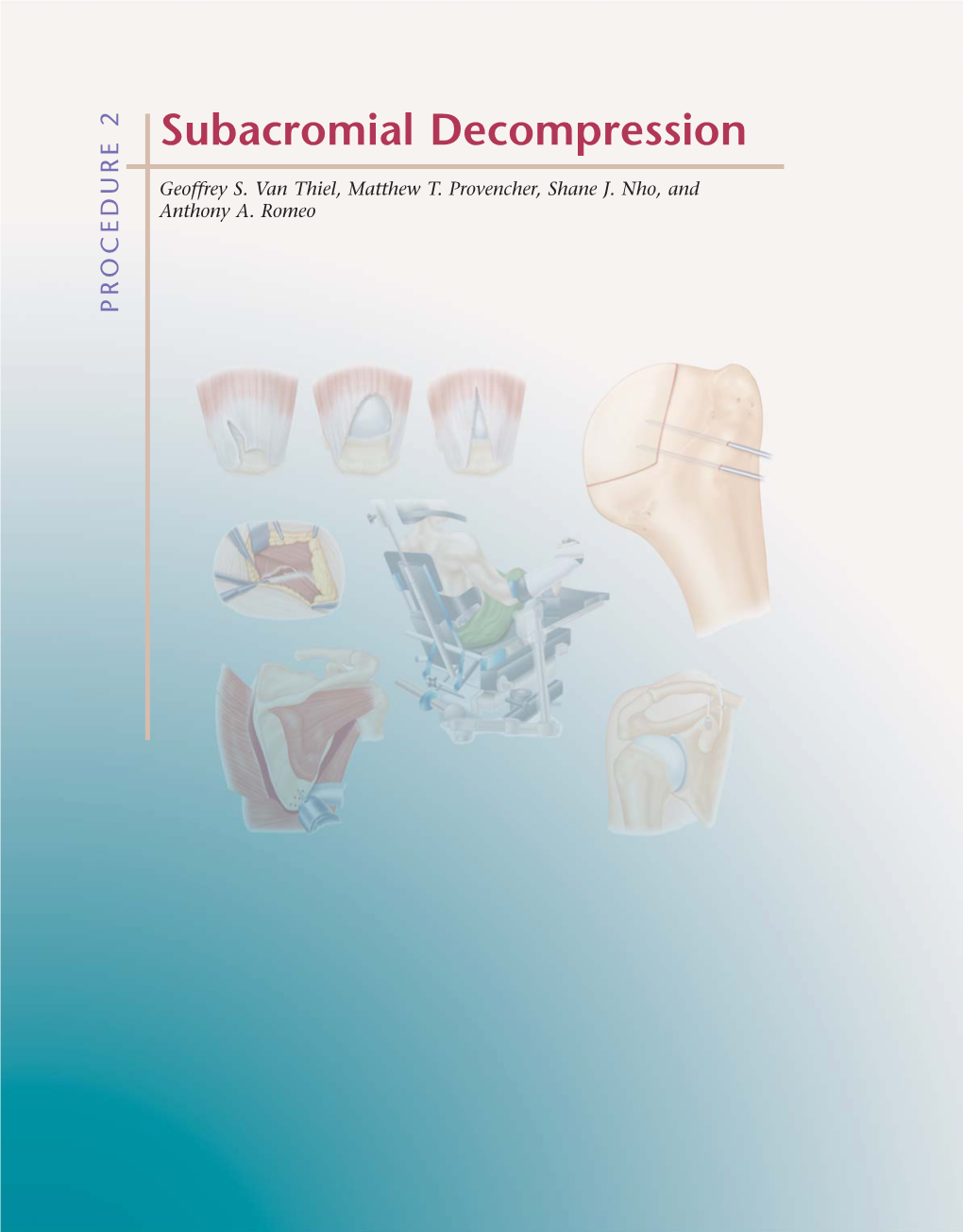 Subacromial Decompression in the Shoulder