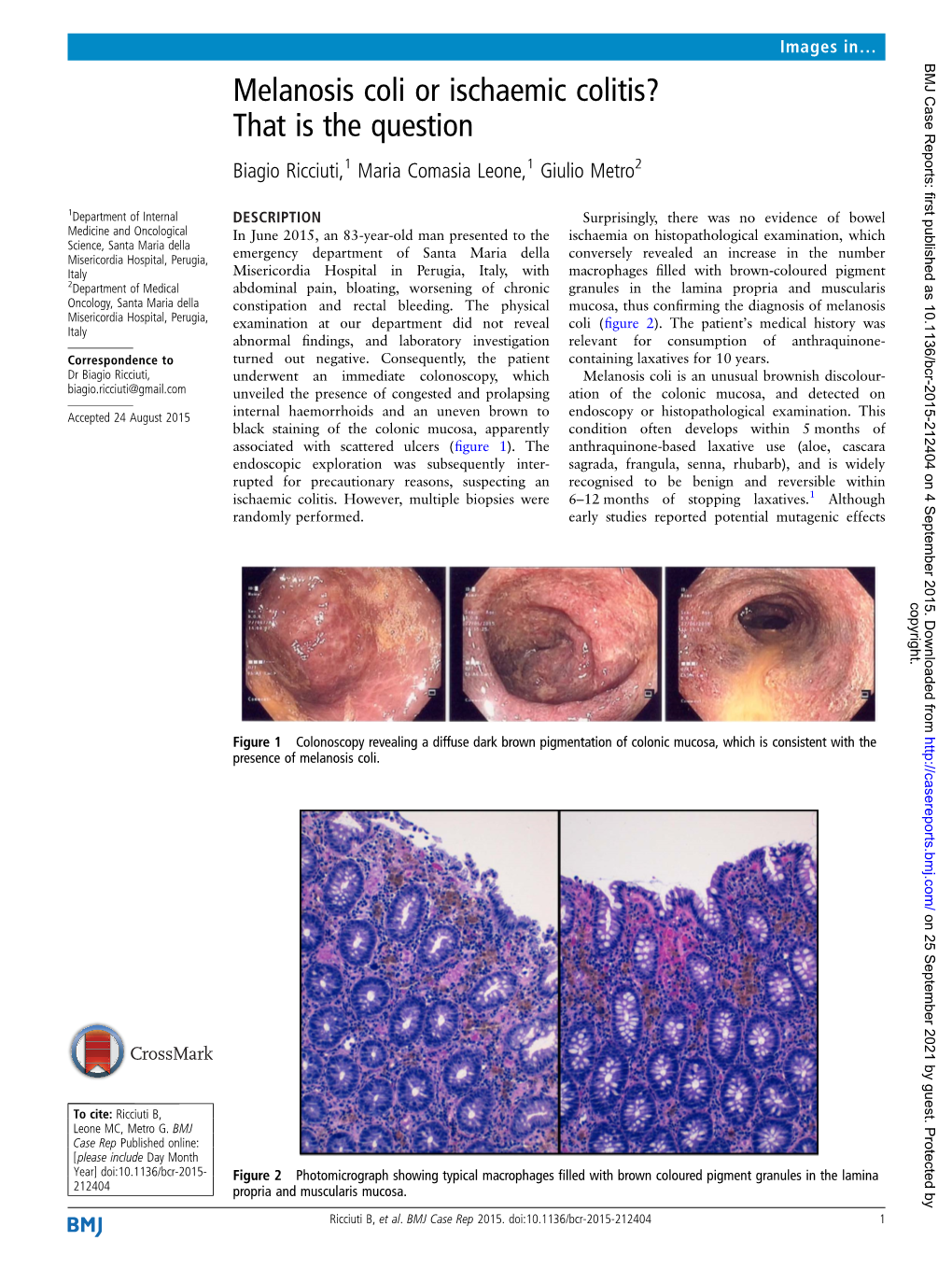 Melanosis Coli Or Ischaemic Colitis? That Is the Question Biagio Ricciuti,1 Maria Comasia Leone,1 Giulio Metro2