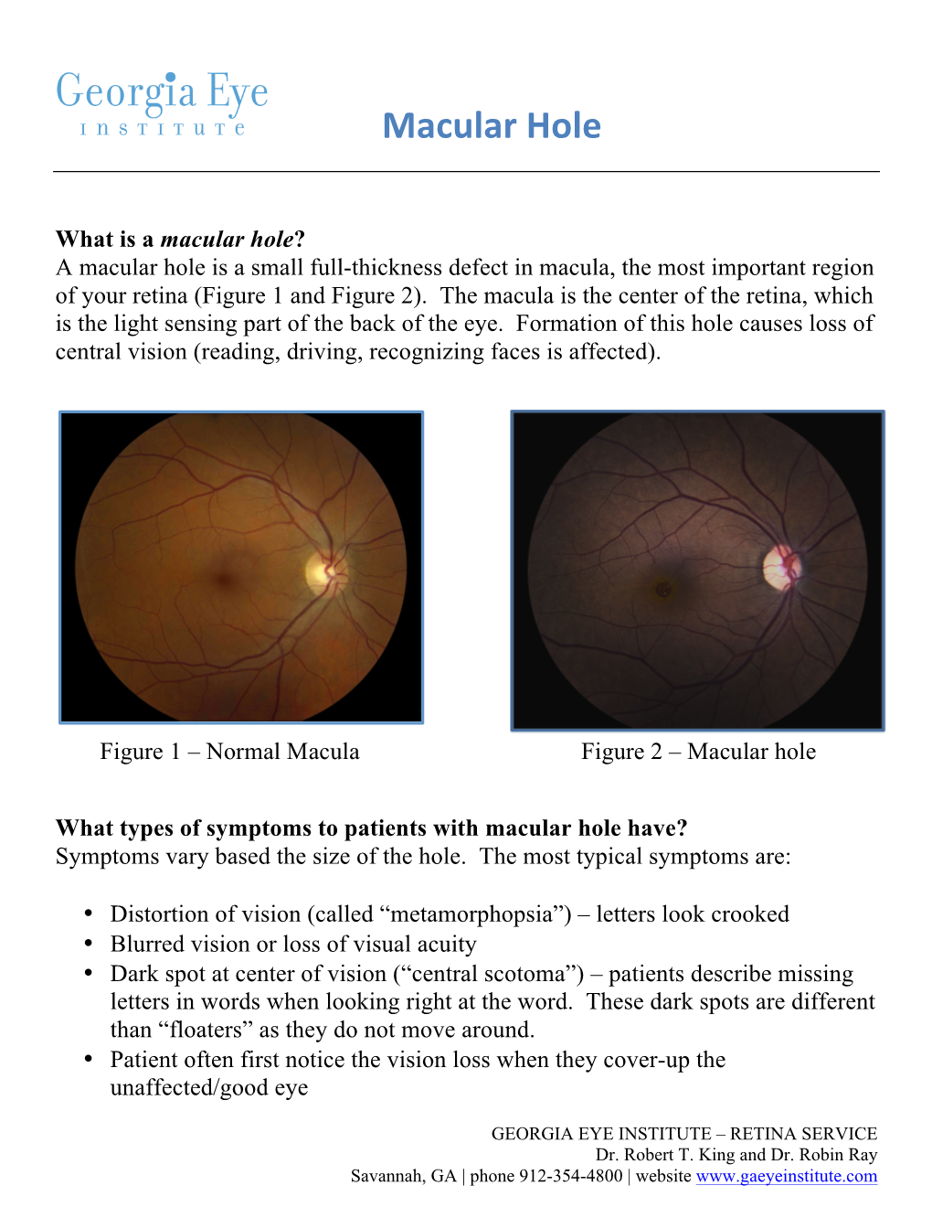 Macular Hole