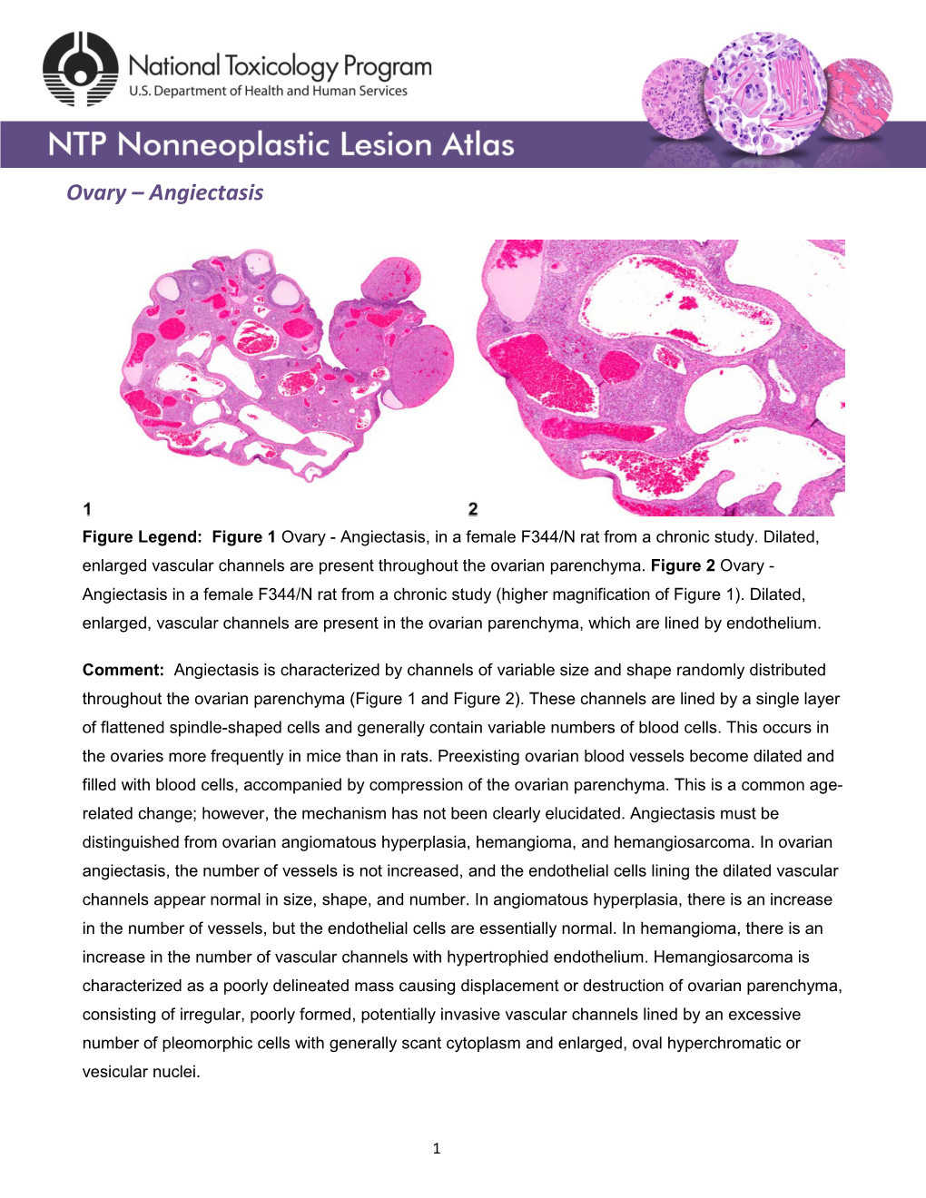 Ovary – Angiectasis