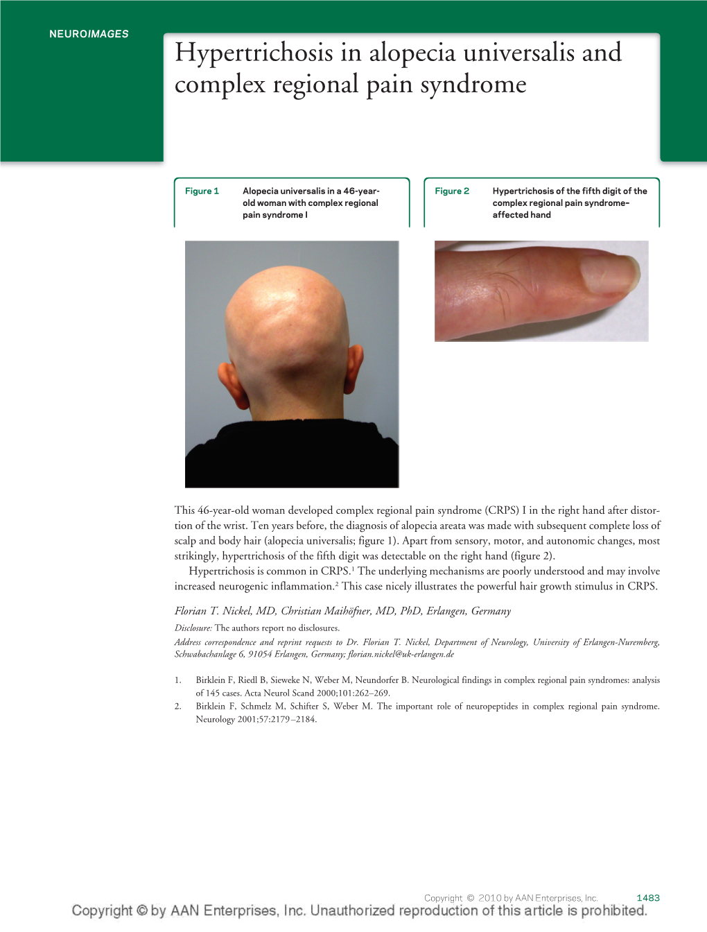 Hypertrichosis in Alopecia Universalis and Complex Regional Pain Syndrome