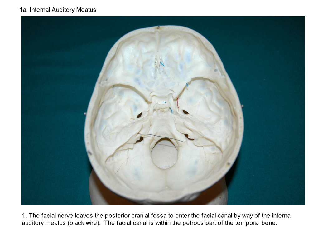 1A. Internal Auditory Meatus