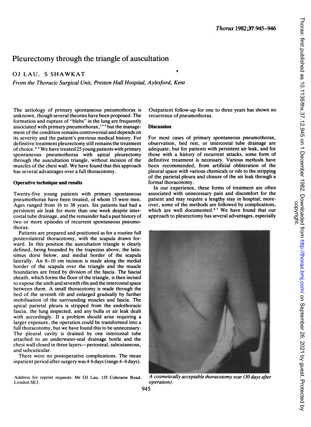 Pleurectomy Through the Triangle of Auscultation