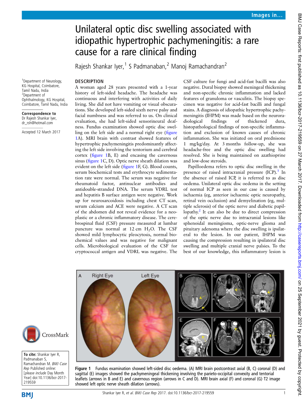 Unilateral Optic Disc Swelling Associated with Idiopathic