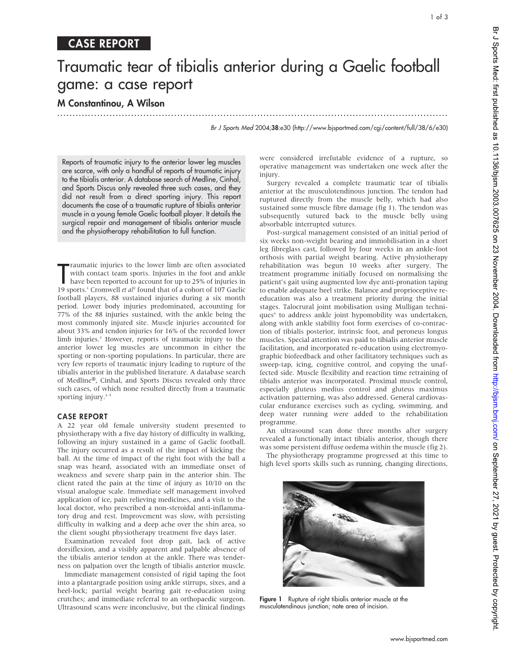 Traumatic Tear of Tibialis Anterior During a Gaelic Football Game: a Case Report M Constantinou, a Wilson