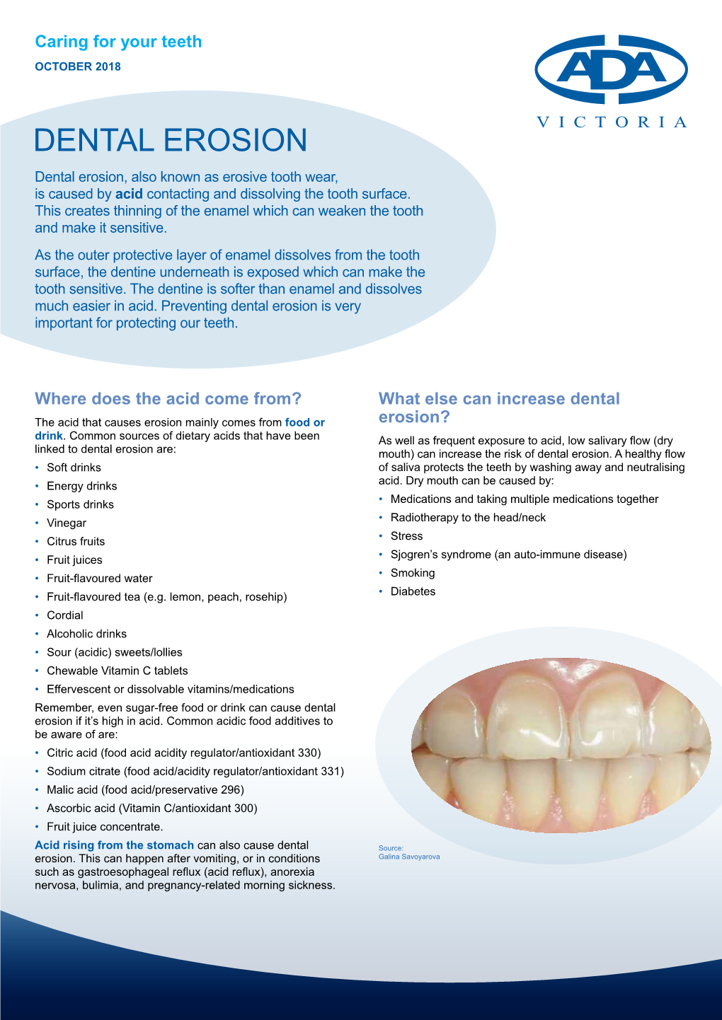DENTAL EROSION Dental Erosion, Also Known As Erosive Tooth Wear, Is Caused by Acid Contacting and Dissolving the Tooth Surface