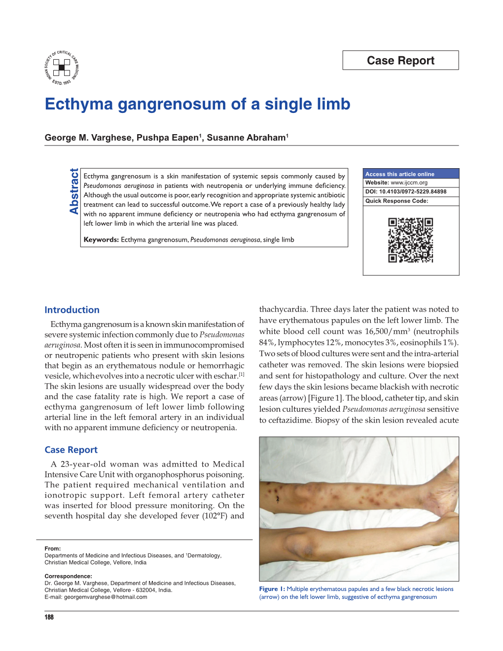 Ecthyma Gangrenosum of a Single Limb