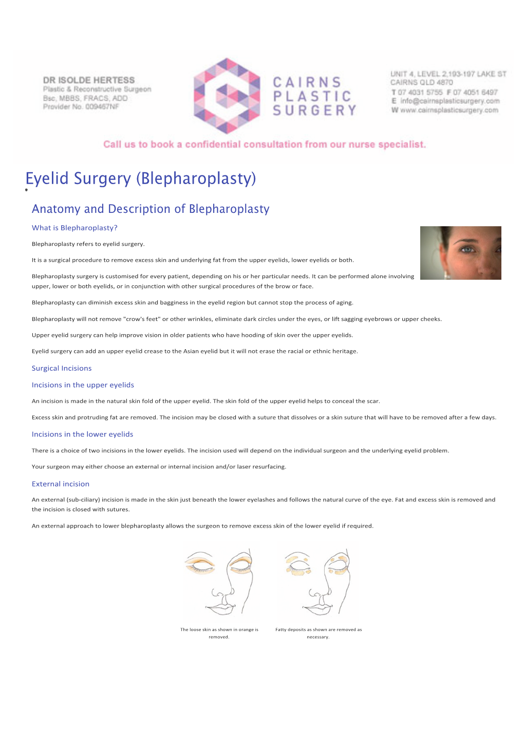 Eyelid Surgery (Blepharoplasty)