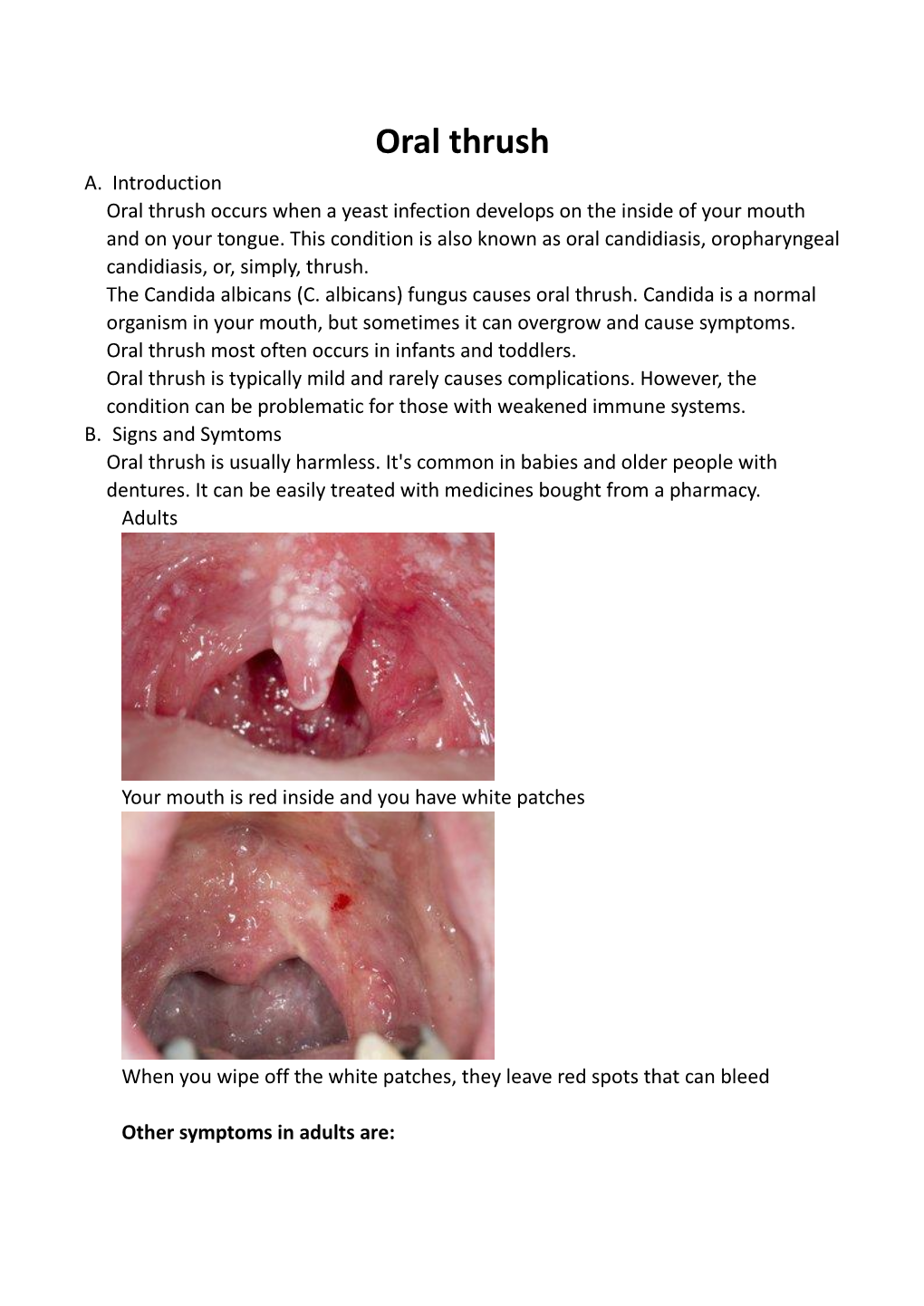 Oral Thrush A