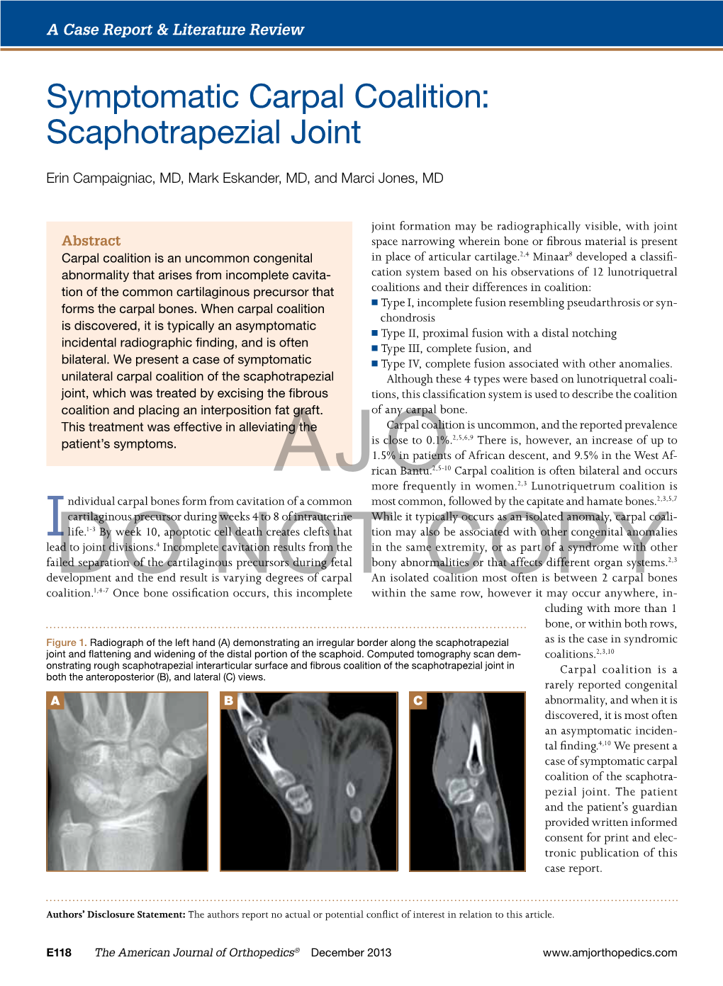 Symptomatic Carpal Coalition: Scaphotrapezial Joint