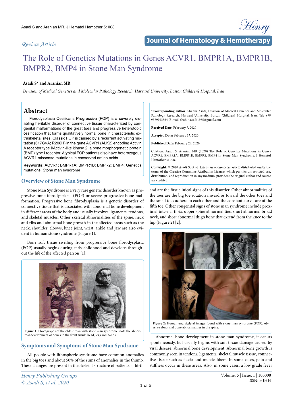 The Role of Genetics Mutations in Genes ACVR1, BMPR1A, BMPR1B, BMPR2, BMP4 in Stone Man Syndrome