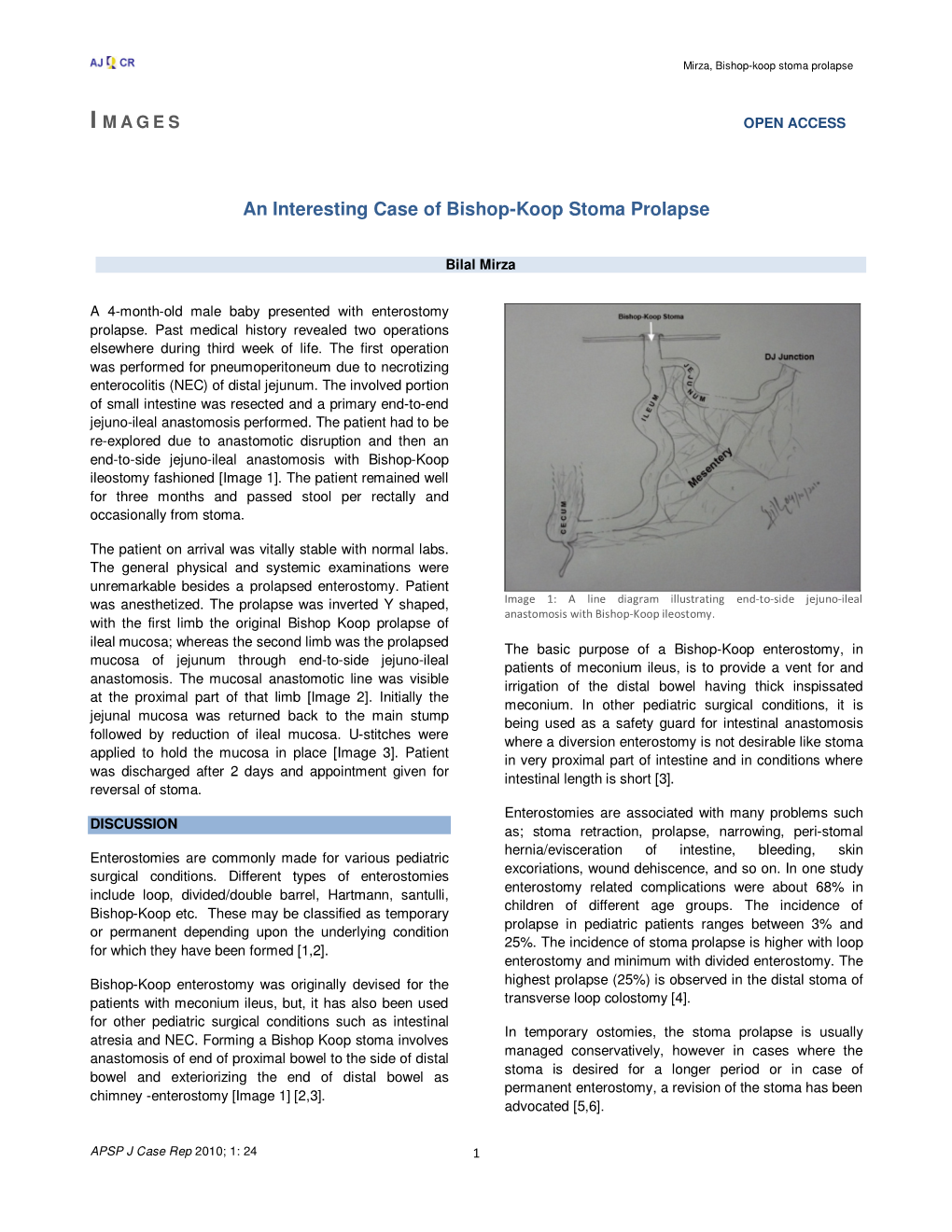 An Interesting Case of Bishop-Koop Stoma Prolapse