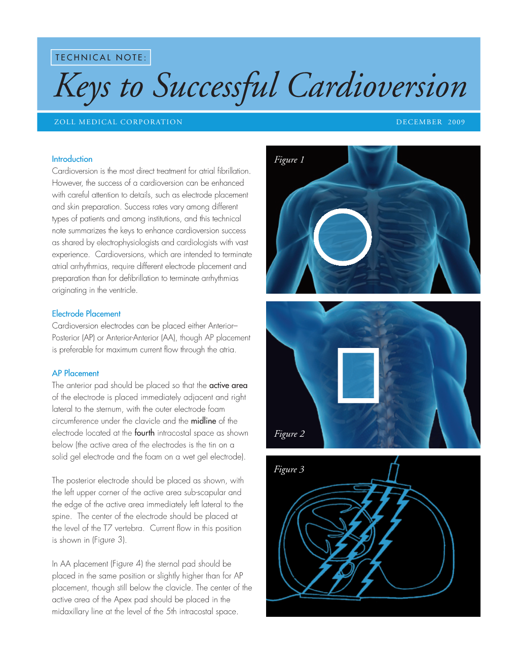 Keys to Successful Cardioversion