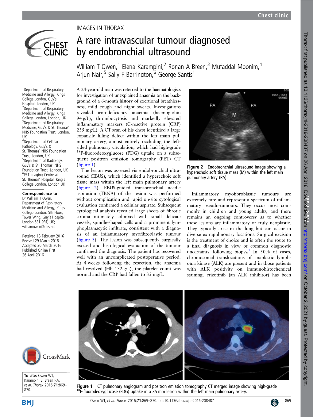 A Rare Intravascular Tumour Diagnosed by Endobronchial Ultrasound