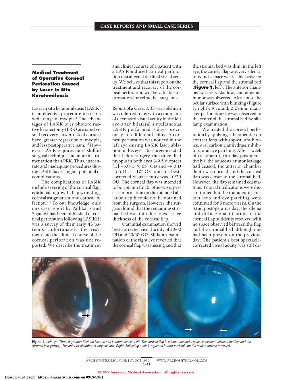 Medical Treatment of Operative Corneal Perforation Caused By