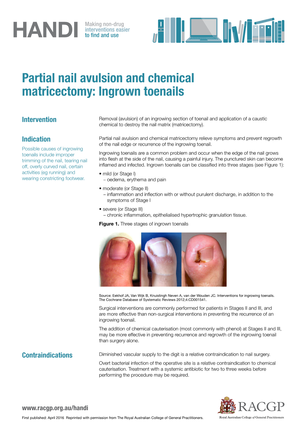 Partial Nail Avulsion and Chemical Matricectomy: Ingrown Toenails