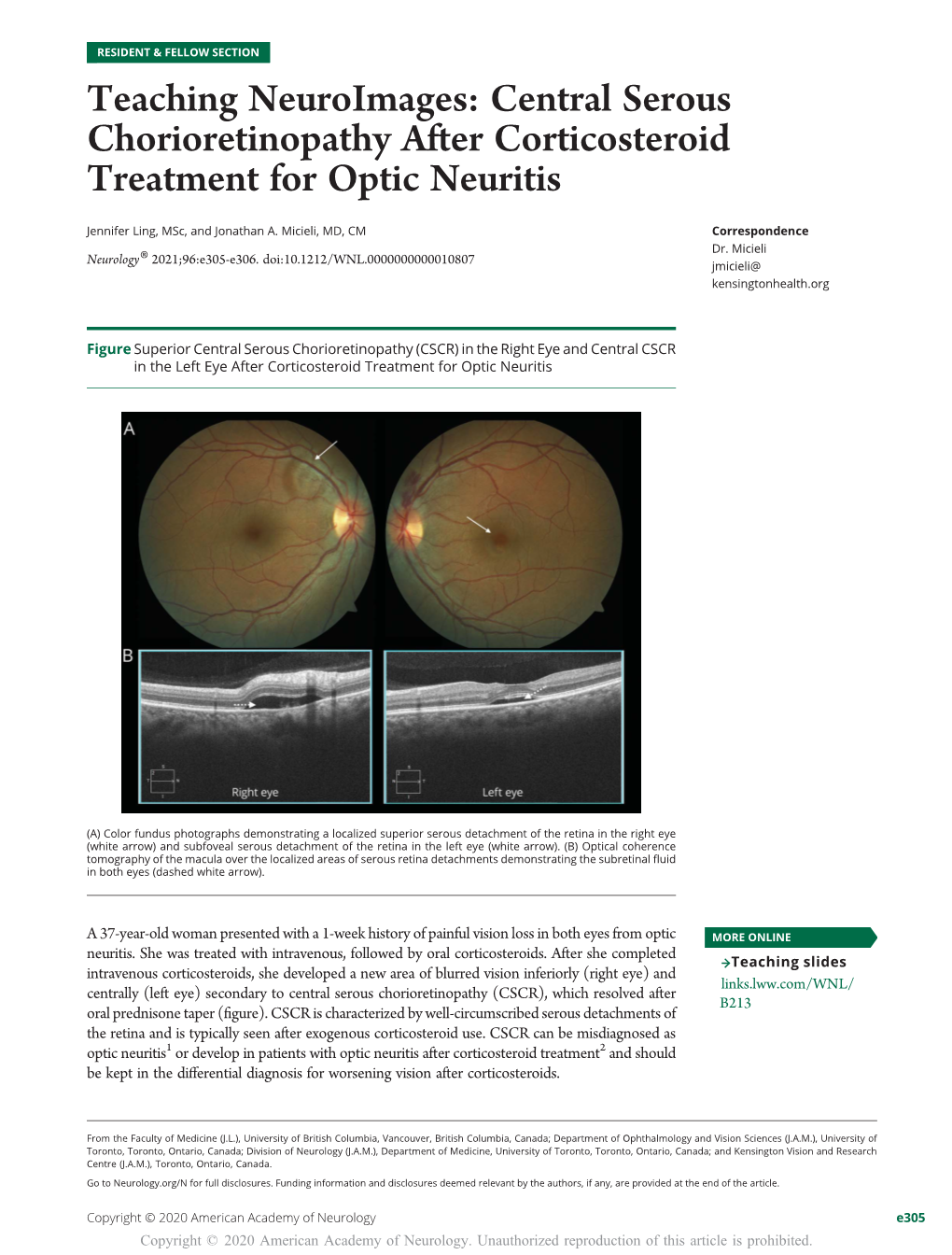 Teaching Neuroimages: Central Serous Chorioretinopathy After Corticosteroid Treatment for Optic Neuritis