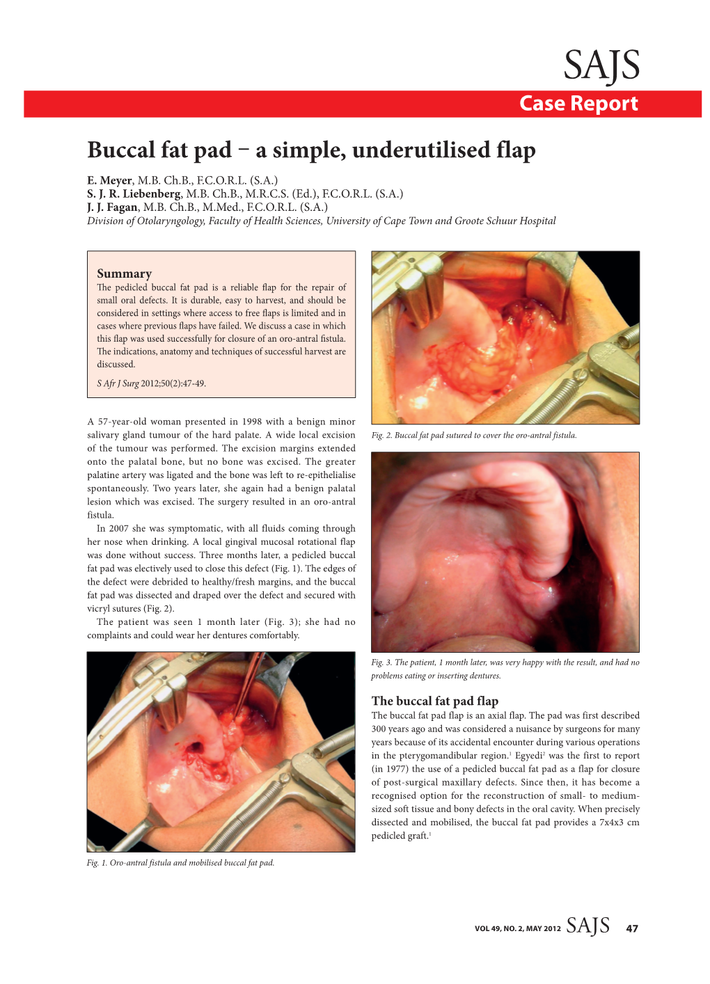 Buccal Fat Pad – a Simple, Underutilised Flap E