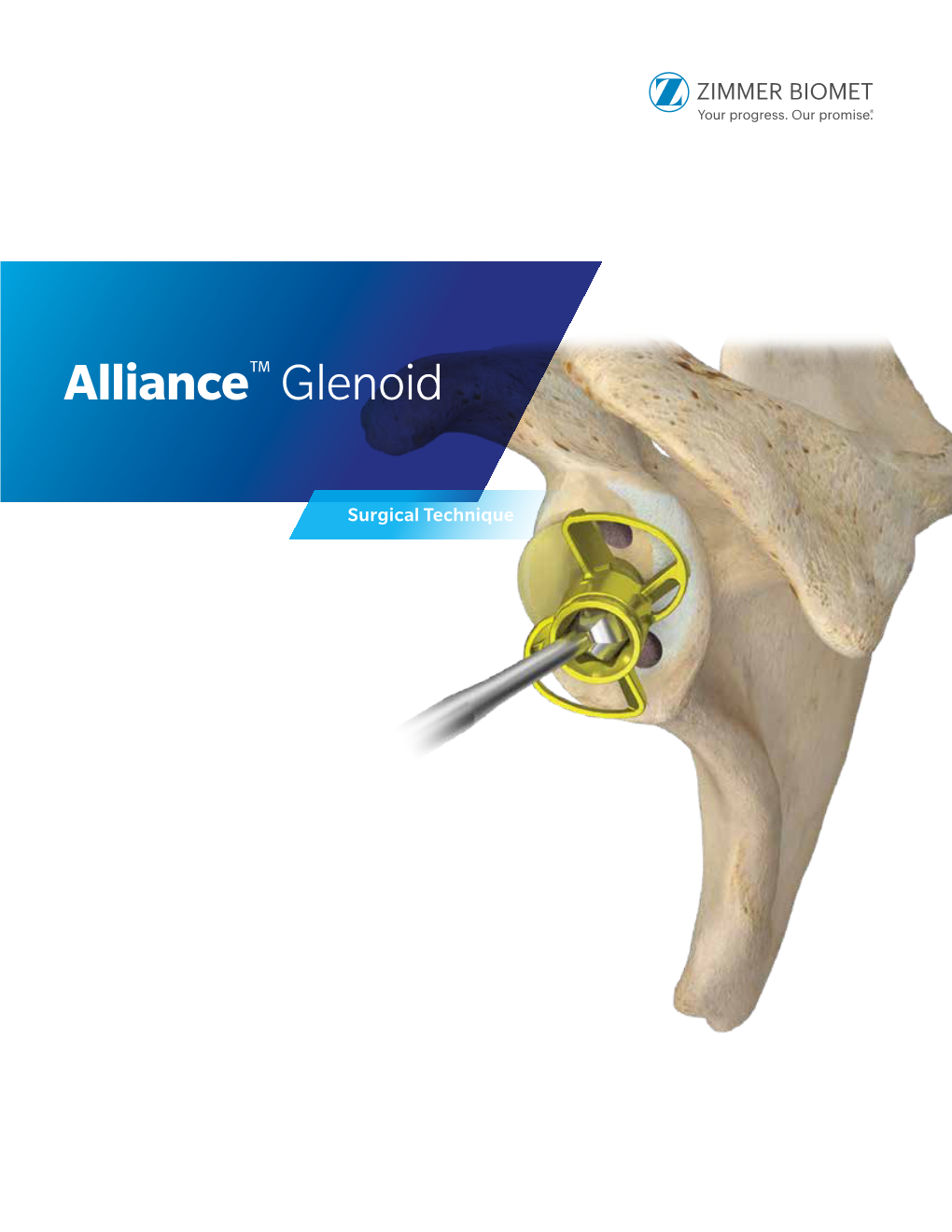 Alliance Glenoid Surgical Technique