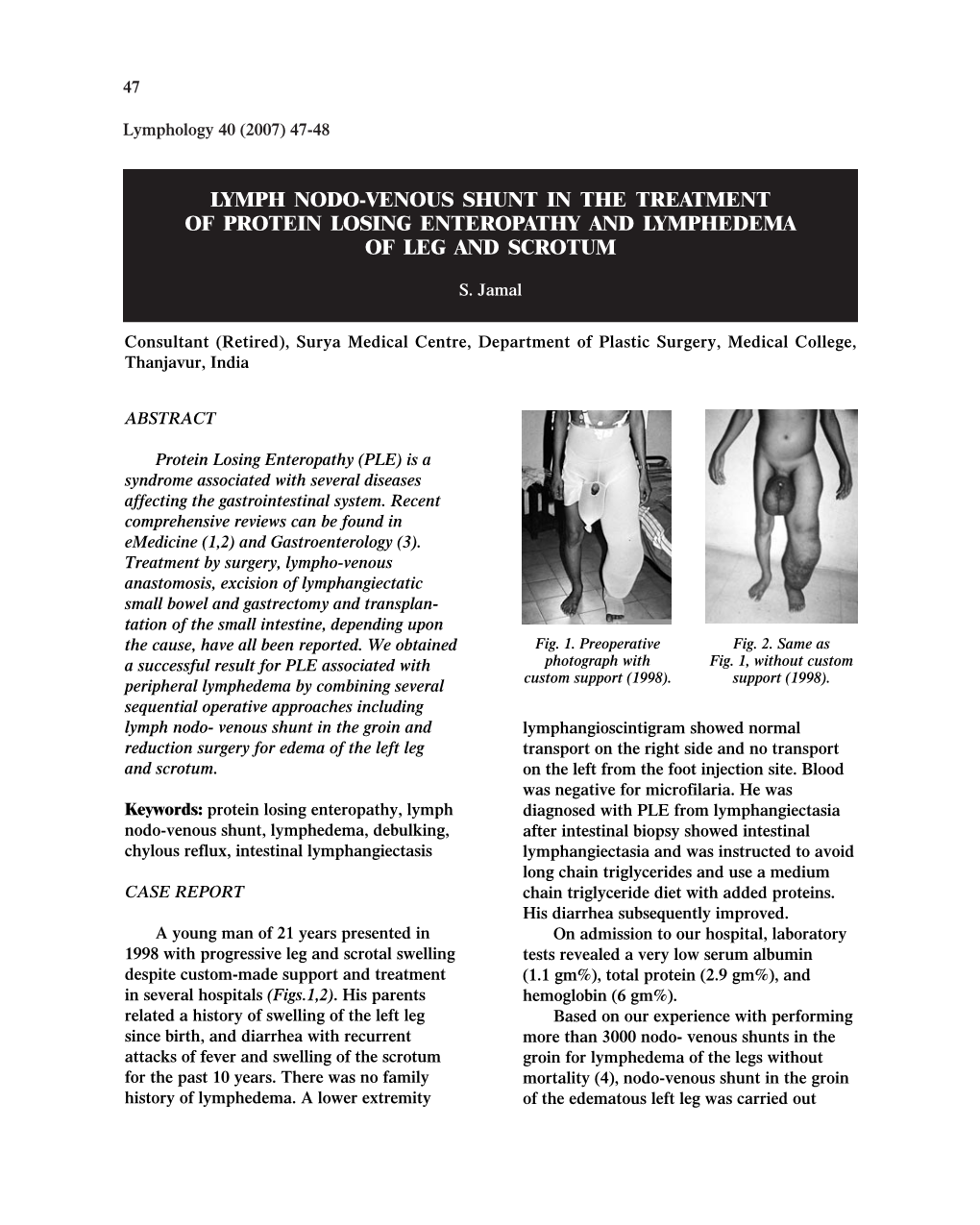 Lymph Nodo-Venous Shunt in the Treatment of Protein Losing Enteropathy and Lymphedema of Leg and Scrotum