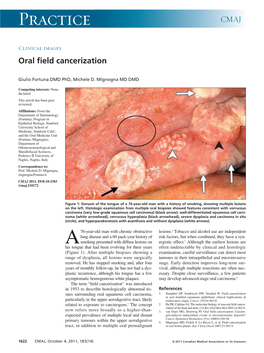 Oral Field Cancerization