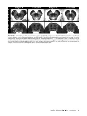 ON-LINE FIG 1. Selected Images of the Caudal Midbrain (Upper Row