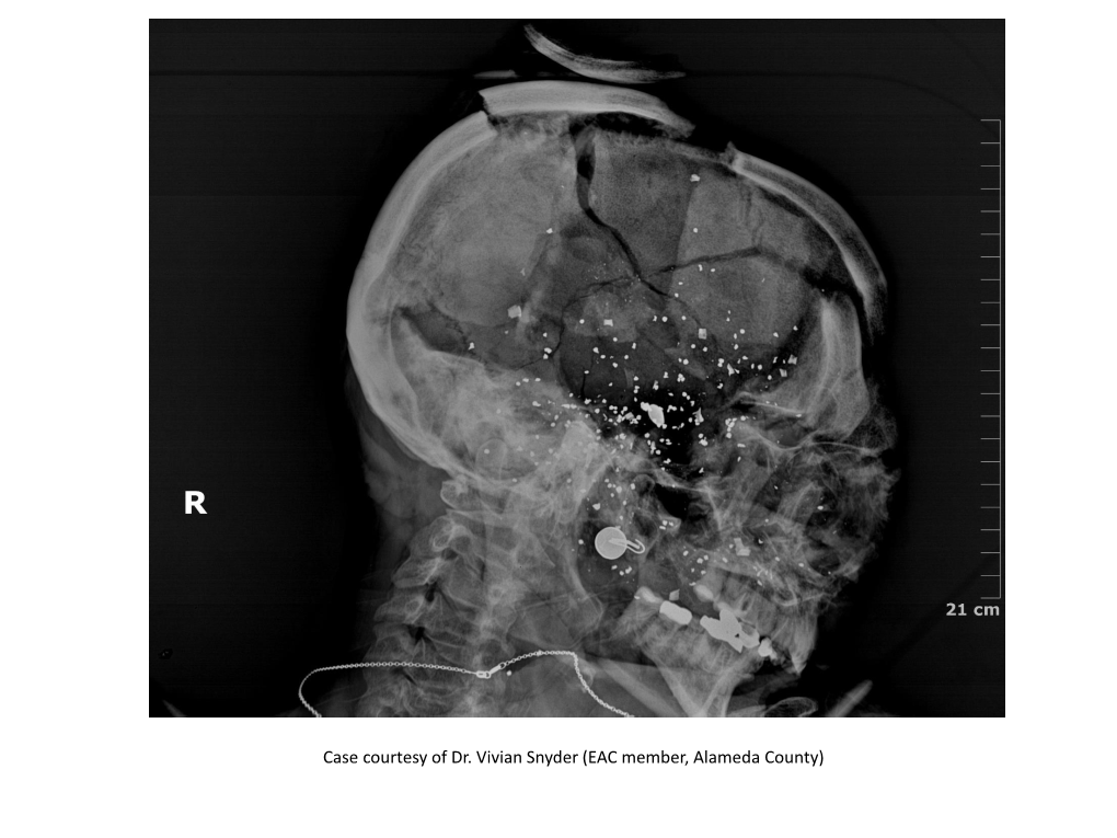 Case Courtesy of Dr. Vivian Snyder (EAC Member, Alameda County)