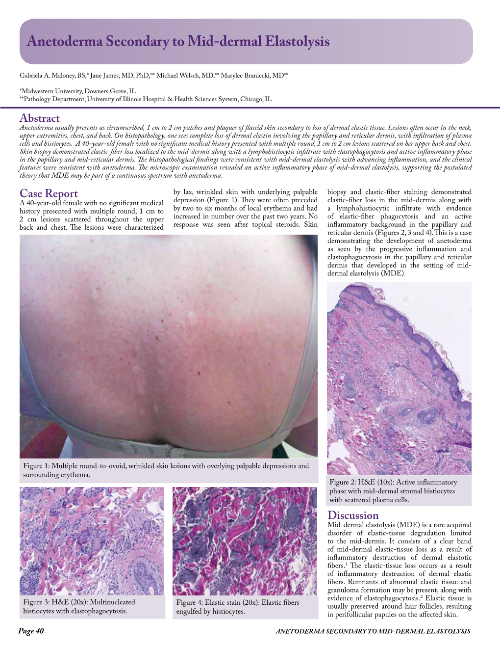 Anetoderma Secondary to Mid-Dermal Elastolysis