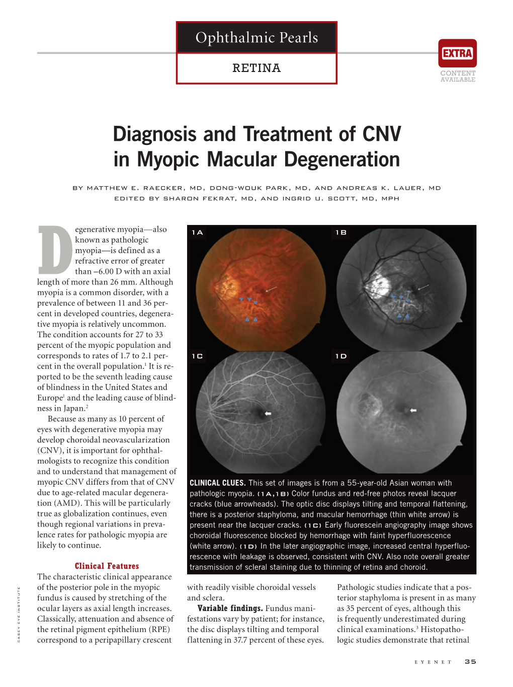 Diagnosis and Treatment of CNV in Myopic Macular Degeneration