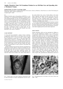 Annular Elastolytic Giant Cell Granuloma Produced on an Old Burn Scar and Spreading After a Mechanical Trauma